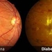 RETINOPATIA DIABETICA